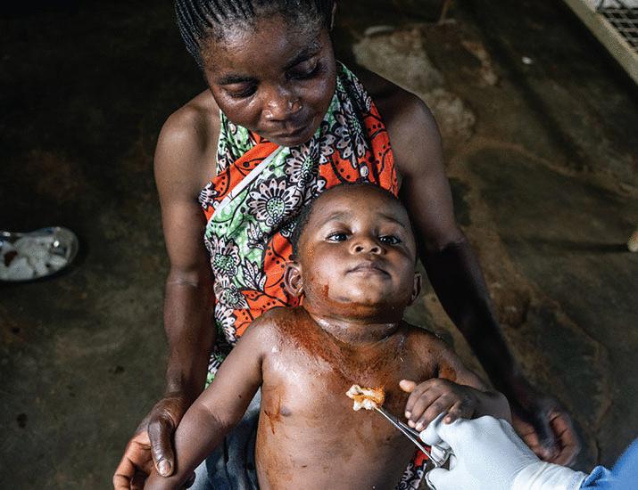 Conflict drives mpox epidemic in eastern DRC | Science